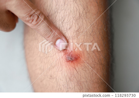 A man verruca vulgaris his leg. Causes of Symptoms of Human Papilloma Virus infection in wounds causes bumps and rough skin. Healthcare medical concept. 118293730