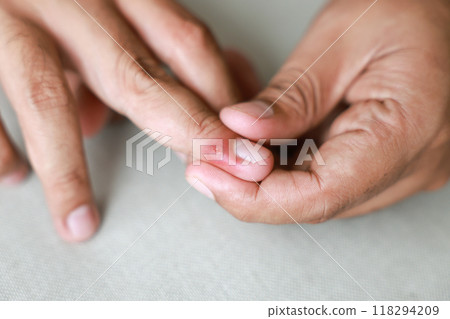 Young man injured his finger and it was swollen and red. Cause of pain include Infected wound. male showing small wound marks on right hand. injured finger. concept of Health care, medical. Young man injured his finger and it was swollen and red. Cause of pain include Infected wound. male showing small wound marks on right hand. injured finger. concept of Health care, medical. 118294209