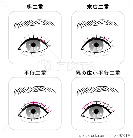 雙眼皮的類型 118297019