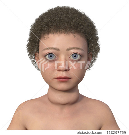 A child with Graves disease, 3D illustration A child with Graves disease, 3D illustration 118297769