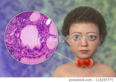 A child with Graves disease, 3D illustration A child with Graves disease, 3D illustration 118297775
