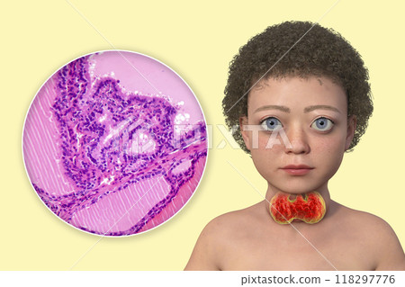 A child with Graves disease, 3D illustration A child with Graves disease, 3D illustration 118297776