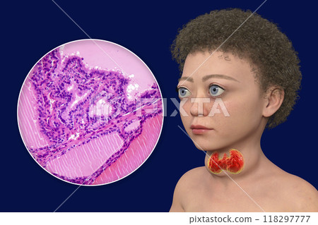 A child with Graves disease, 3D illustration A child with Graves disease, 3D illustration 118297777