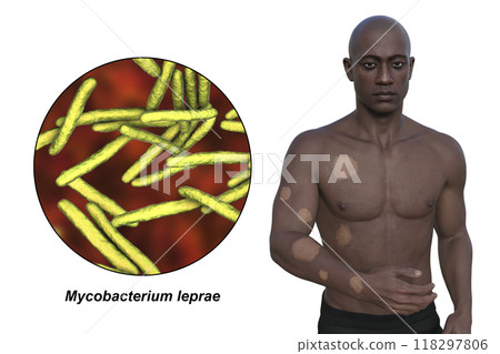 Tuberculoid leprosy, 3D illustration Tuberculoid leprosy, 3D illustration 118297806