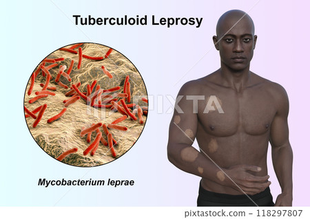 Tuberculoid leprosy, 3D illustration Tuberculoid leprosy, 3D illustration 118297807