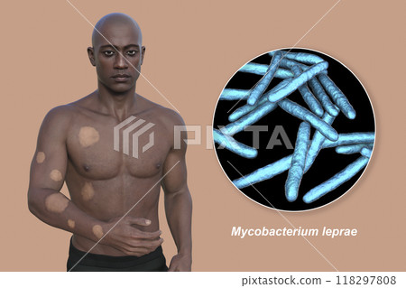 Tuberculoid leprosy, 3D illustration Tuberculoid leprosy, 3D illustration 118297808