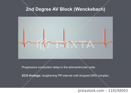 ECG of 2nd degree AV block Wenckebach , 3D illustration 118298083