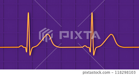 Long QT syndrome ECG, 1st type, 3D illustration 118298103