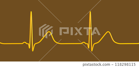 Long QT syndrome ECG, 1st type, 3D illustration Long QT syndrome ECG, 1st type, 3D illustration 118298115