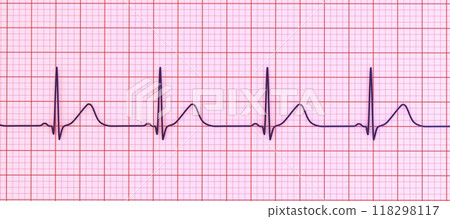 Long QT syndrome ECG, 1st type, 3D illustration Long QT syndrome ECG, 1st type, 3D illustration 118298117