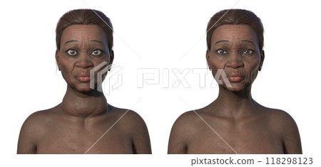 An African woman with Graves' disease and her healthy counterpart, 3D illustration An African woman with Graves' disease and her healthy counterpart, 3D illustration 118298123