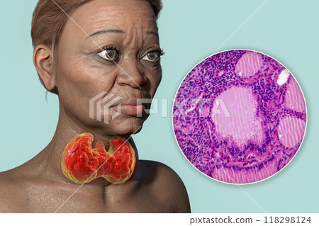 Grave's disease in a woman, 3D illustration and light micrograph of toxic goiter Grave's disease in a woman, 3D illustration and light micrograph of toxic goiter 118298124