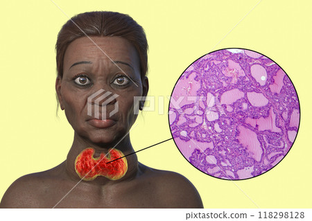 Grave's disease in a woman, 3D illustration and light micrograph of toxic goiter 118298128