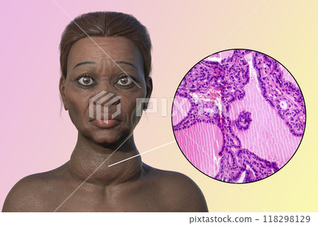 Grave's disease in a woman, 3D illustration and light micrograph of toxic goiter 118298129