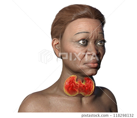 Grave's disease in a woman, 3D illustration 118298132