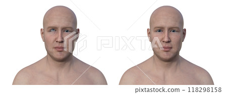 A man with hypertropia and a healthy person, 3D illustration 118298158