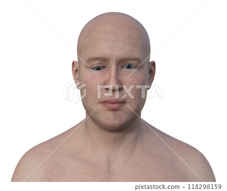 A man with hypotropia, 3D illustration A man with hypotropia, 3D illustration 118298159