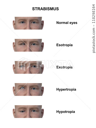 A man with various strabismus types, 3D illustration 118298164