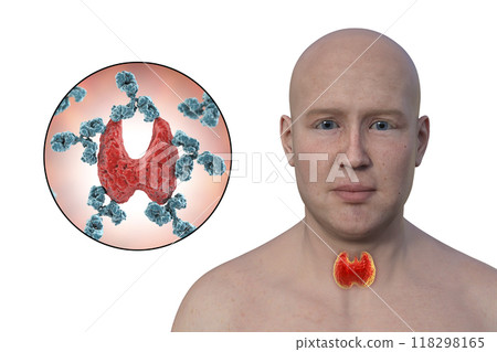Hashimoto's thyroiditis, conceptual 3D illustration 118298165
