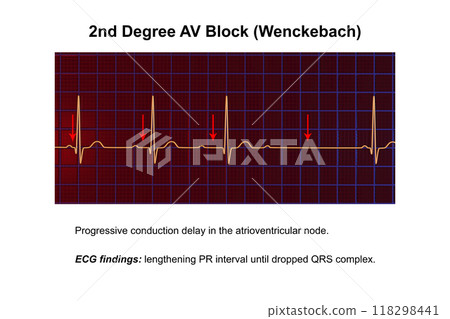 ECG of 2nd degree AV block Wenckebach , 3D illustration 118298441