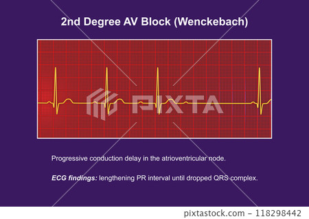 ECG of 2nd degree AV block Wenckebach , 3D illustration 118298442