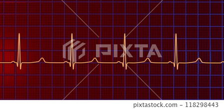 ECG of type 3 long QT syndrome, 3D illustration 118298443