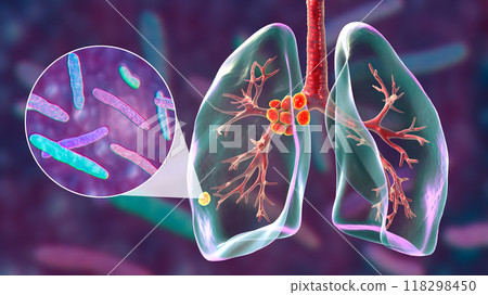 Primary lung tuberculosis, 3D illustration Primary lung tuberculosis, 3D illustration 118298450