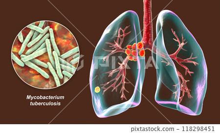 Primary lung tuberculosis, 3D illustration Primary lung tuberculosis, 3D illustration 118298451