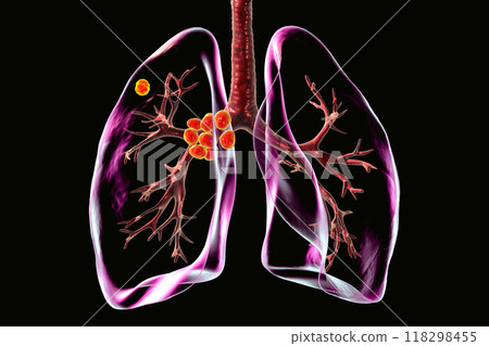 Primary lung tuberculosis, 3D illustration Primary lung tuberculosis, 3D illustration 118298455