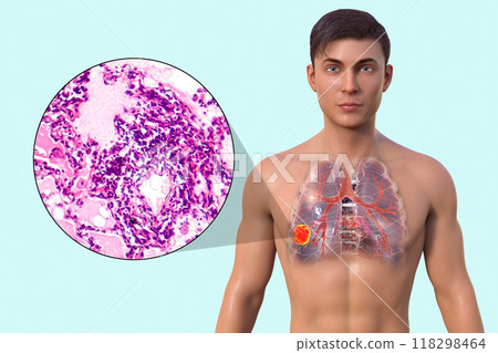 A man with lung cancer, 3D illustration and micrograph 118298464