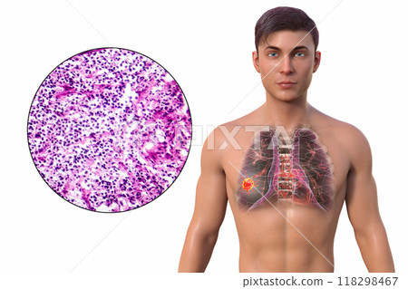 A man with lung cancer, 3D illustration and micrograph 118298467