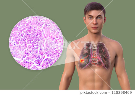 A man with lung cancer, 3D illustration and micrograph 118298469