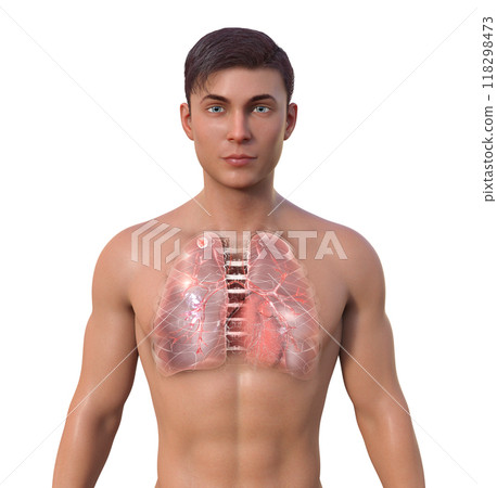Lung tuberculosis, 3D illustration. Lung tuberculosis, 3D illustration. 118298473