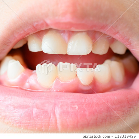 牙齒掉了 118319459