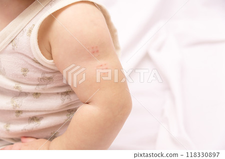 [Baby's arm after BCG vaccination] 118330897