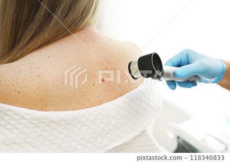 close-up - a dermatologist examines moles and skin growths on the patient's body using a special device - a dermatoscope. Diagnosis and prevention of melanoma. 118340833