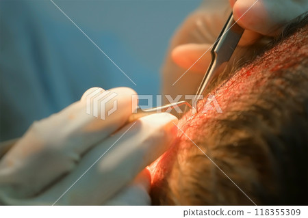 Surgeon makes hair transplantation on head of bald man, alopecia cure in clinic. 118355309