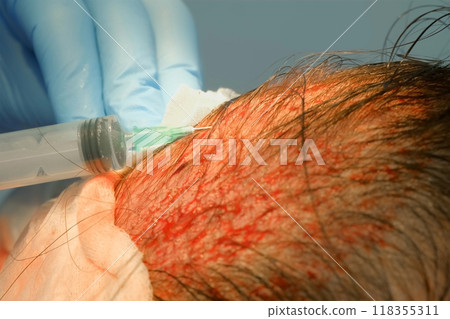 Surgeon making injection of anesthesia in head of bald patient hair transplant. 118355311
