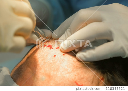 Surgeon cuts out hair grafts from patient head using punch to hair transplant. Surgeon cuts out hair grafts from patient head using punch to hair transplant. 118355321
