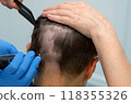 Doctor hands in gloves cutting patient hair with clipper before hair transplant. 118355326