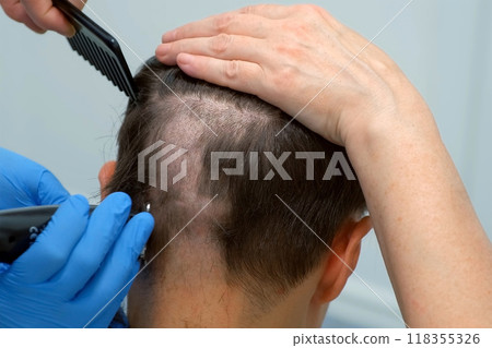 Doctor hands in gloves cutting patient hair with clipper before hair transplant. Doctor hands in gloves cutting patient hair with clipper before hair transplant. 118355326