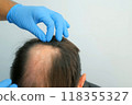 Doctor hands in gloves touching bald part of skin on man patient head. 118355327