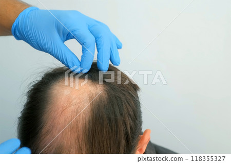 Doctor hands in gloves touching bald part of skin on man patient head. 118355327