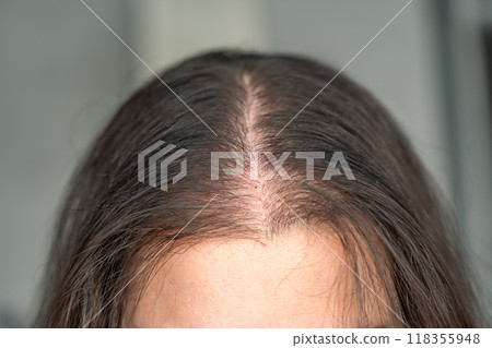 Close-up view of the head with traces of blood from injections after mesotherapy, treatment of alopecia Close-up view of the head with traces of blood from injections after mesotherapy, treatment of alopecia 118355948