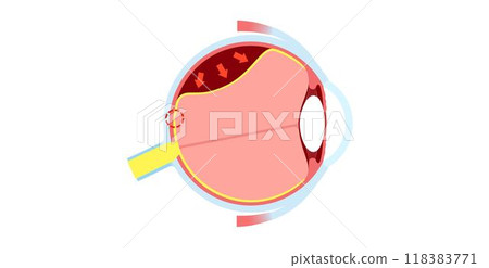 Retinal detachment eye disease Retinal detachment eye disease 118383771
