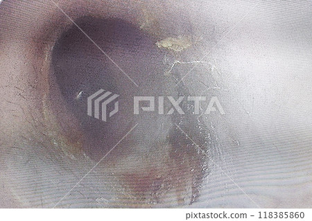 ear wax build up symptoms 118385860