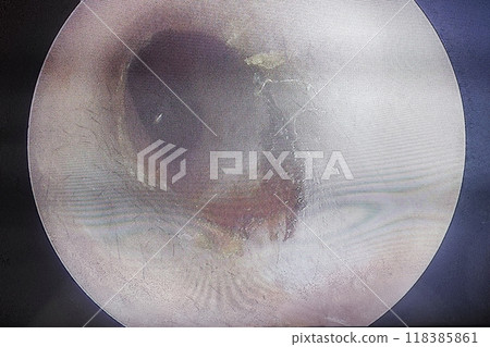 ear wax build up symptoms ear wax build up symptoms 118385861