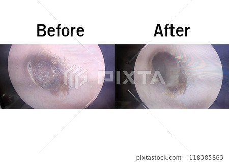 ear wax build up symptoms ear wax build up symptoms 118385863