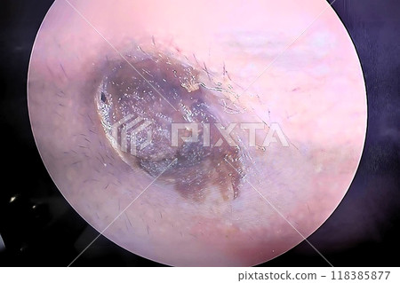 Symptoms of earwax accumulation, photograph inside the ear canal 118385877