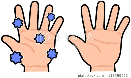 Bacterial hands and clean hands 118399922